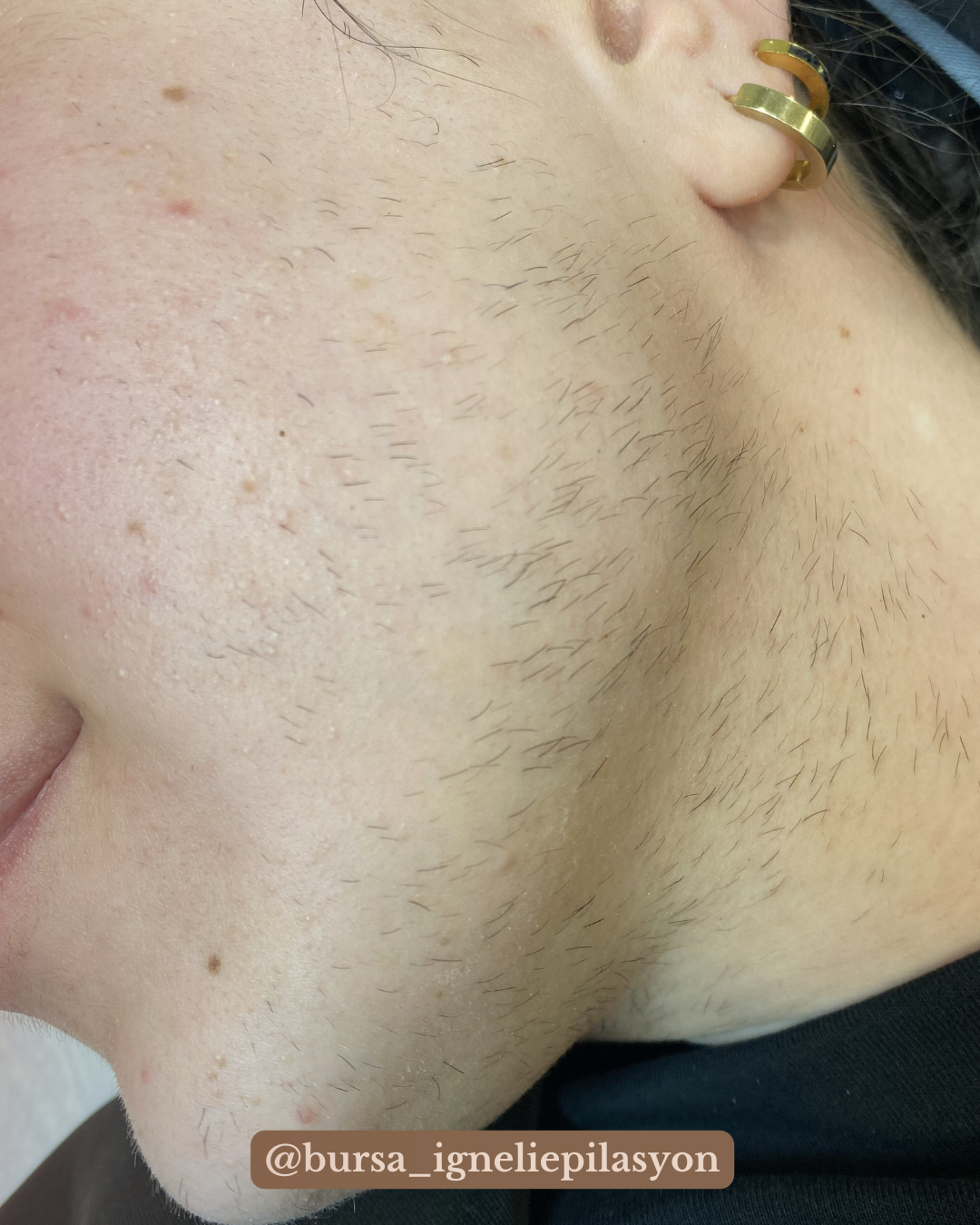 Neden İğneli Epilasyon Yaptırmalısın?