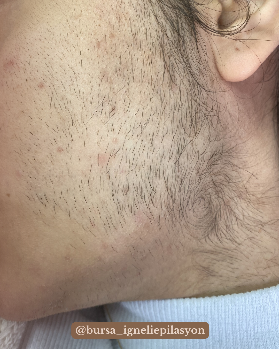 Neden İğneli Epilasyon Yaptırmalısın?