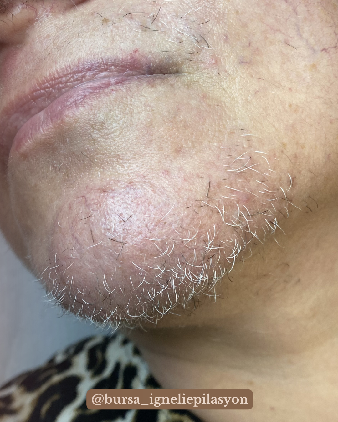 Neden İğneli Epilasyon Yaptırmalısın?